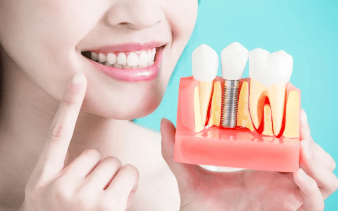 How to Clean and Care for Your Dental Implants: A Long-Term Maintenance Guide