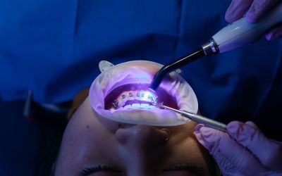 Professional Teeth Whitening vs. Store-Bought Whitening Kits
