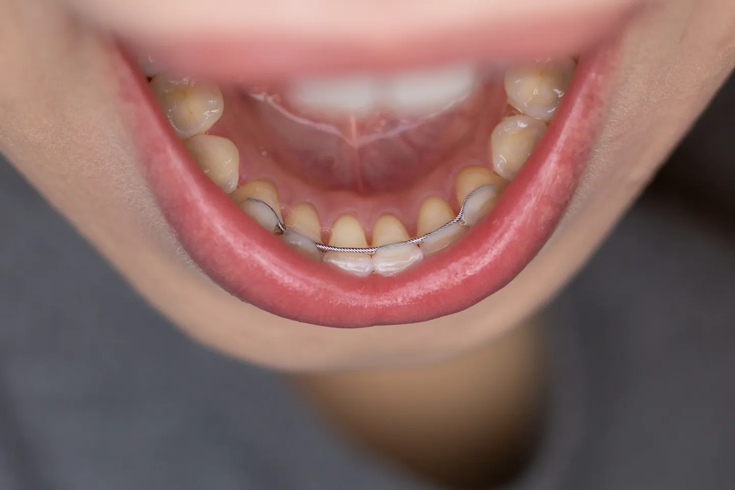 Fixed dental retainer attached behind teeth to maintain alignment