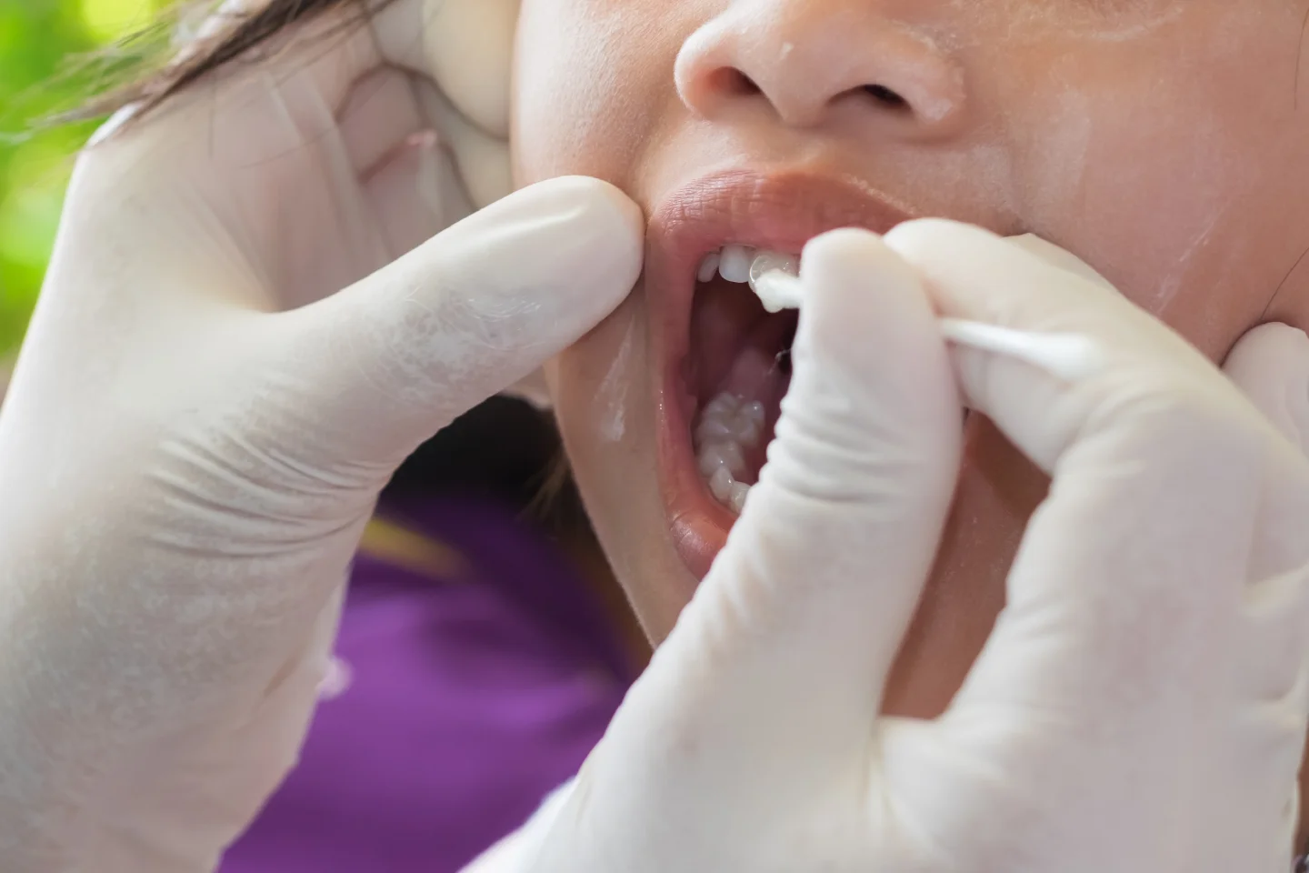 Fluoride treatment to help protect teeth from cavities