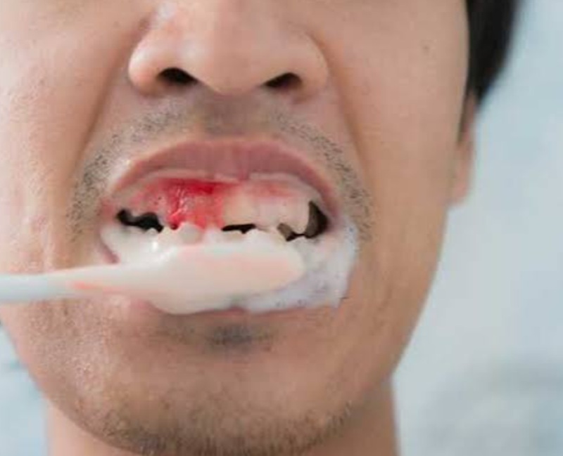 Why Are My Gums Bleeding When I Brush? Common Causes and Treatments!