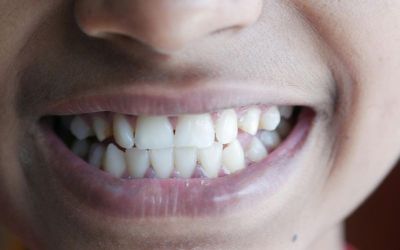 How Teeth Grinding Can Damage Your Smile and What You Can Do About It