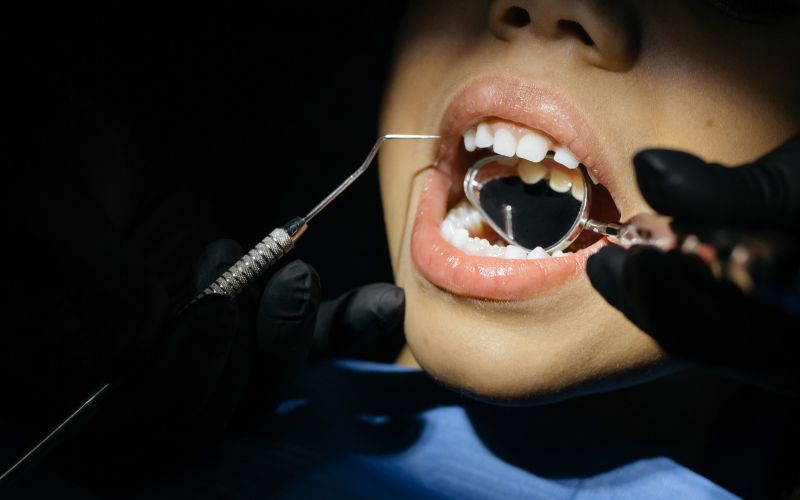 Dental Sealants for Adults: Can They Help Prevent Cavities?